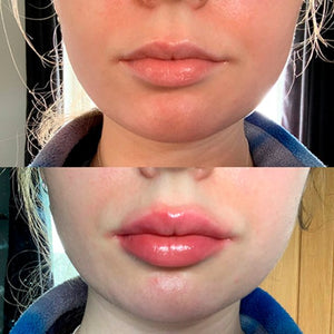 Plump It! DUOSÆT No Needles Lip Filler Kit 2x3 ml (vomulising lip plumper + hyaluronic lip plumper)