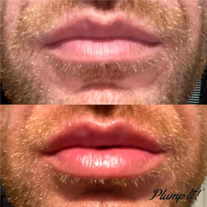 Plump It! DUOSÆT No Needles Lip Filler Kit 2x3 ml (vomulising lip plumper + hyaluronic lip plumper)